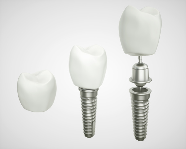 tooth implant disassembled